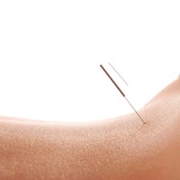 FAQ - Akupunktur