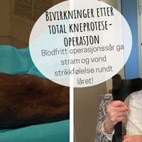 Bivirkninger etter kneproteseoperasjon - stramt og vondt i låret